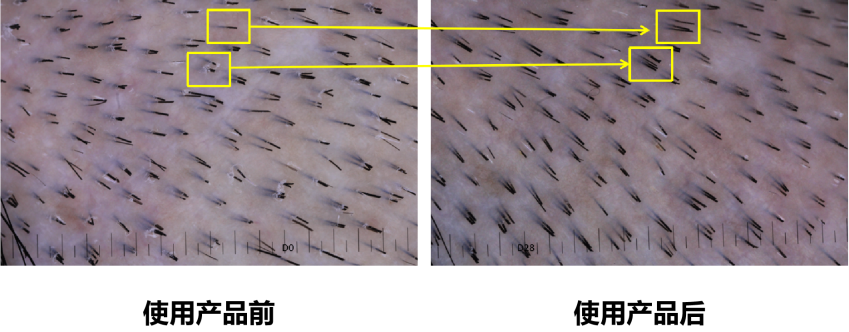 頭皮健康,紅斑,,丘疹,膿皰,評價(jià)方法