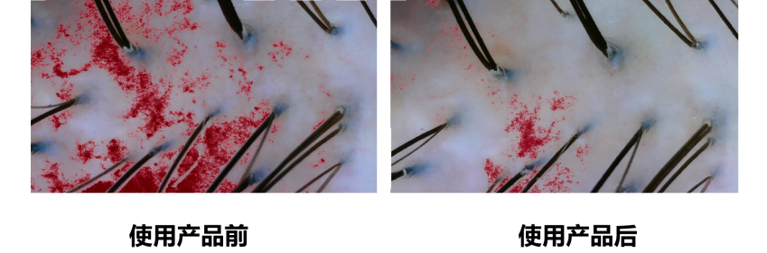 頭皮健康,紅斑,,丘疹,膿皰,評價(jià)方法